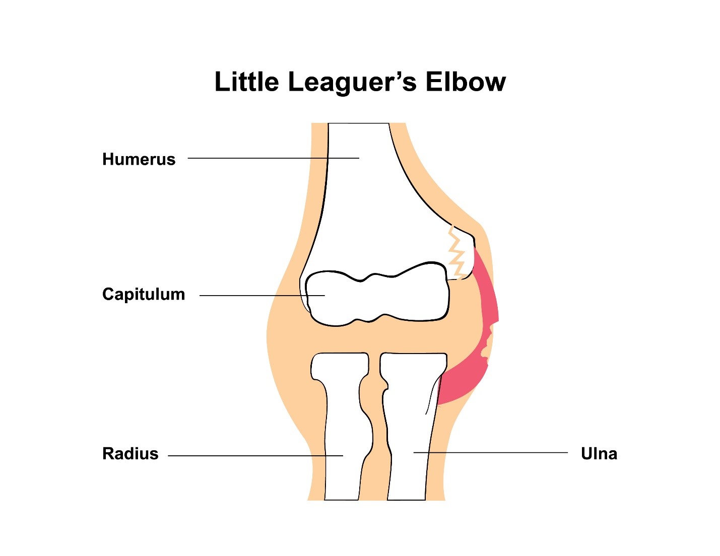 Little Leaguer Elbow